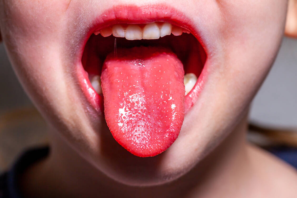 Auch schwere bakterielle Infektionen wie Scharlach können Halsschmerzen verursachen. Hier die typische »Himbeerzunge«. / Foto: Adobe Stock/Lukassek