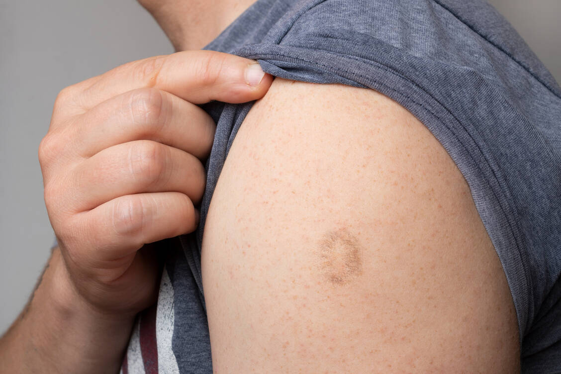 Früher wurde die Pockenimpfung nicht mit einer Kanüle, sondern mit einer Impfpistole verabreicht. Dabei wird die Haut angeritzt. Es entsteht eine kleine Entzündung, die eine Delle hinterlässt. / Foto: Getty Images/Cristian Storto Fotografia