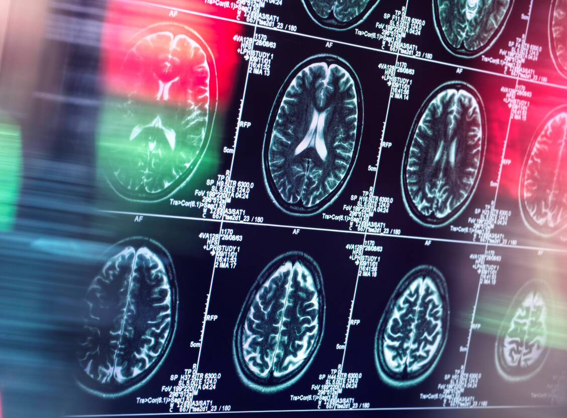 Dass sich im Hirn bei Alzheimer-Patienten Amyloid-Plaques ablagern, ist schon länger bekannt. Neu ist, dass deren Bildung offenbar mit einem Anstieg der intrazellulären Temperatur einhergeht. / Foto: Imago Images/Westend61