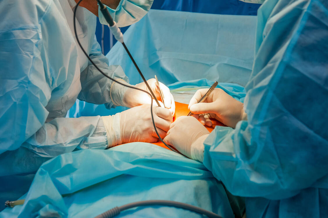Bei Patienten mit schweren chronisch-entzündlichen Darmerkrankungen müssen mitunter Teile des Darms operativ entfernt werden. Es resultiert ein Kurzdarmsyndrom. / Foto: Adobe Stock/okrasiuk