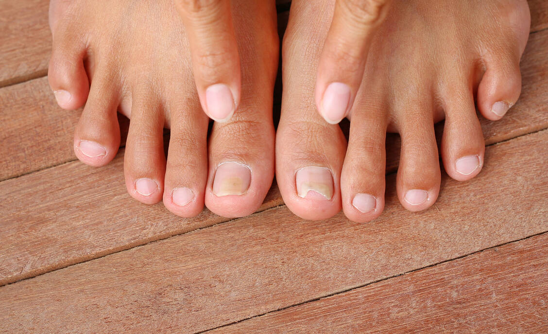 Nagelpilzbehandlung ist eine Geduldsprobe. Umso wichtiger ist es, die individuell passende Behandlung auszuwählen. / Foto: Adobe Stock/zilvergolf