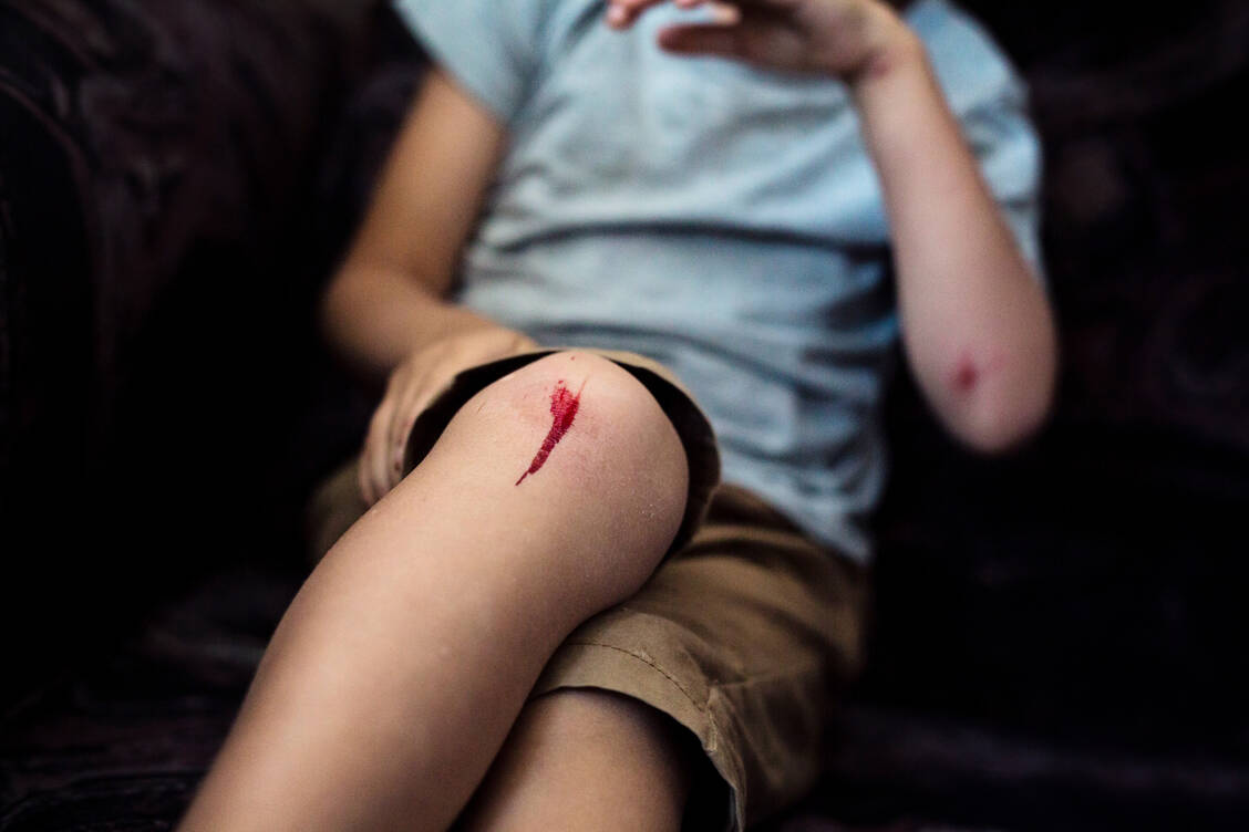 Auch kleine Wunden können zu einer lebensbedrohlichen Sepsis führen, wenn sie nicht sofort gesäubert werden und sich Keime Zugang zur Blutbahn verschaffen. / Foto: Getty Images/Martins Rudzitis