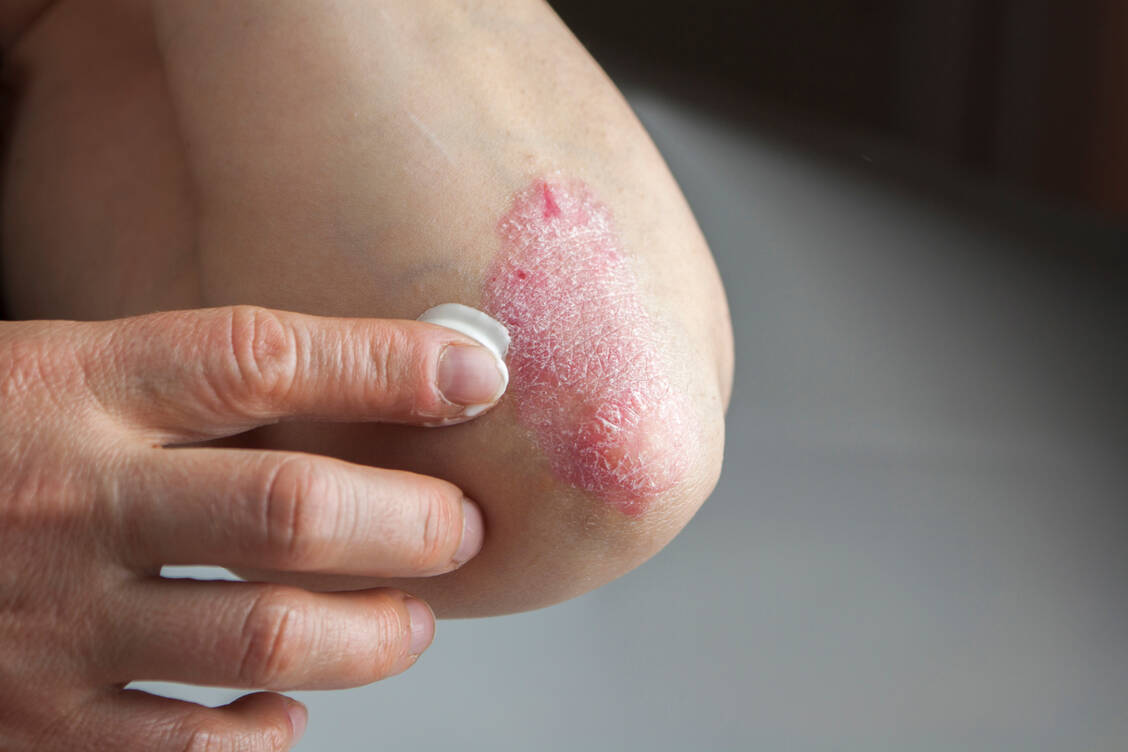 Für die Lokalbehandlung der Plaque-Psoriasis gibt es in den USA einen neuen zugelassenen Arzneistoff. Das Wirkprinzip von Tapinarof ist innovativ. / Foto: Adobe Stock/hriana