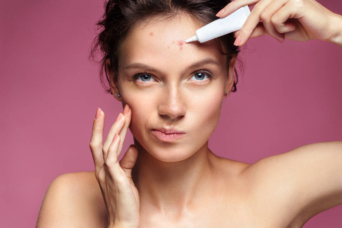 Nicht drücken, sondern lieber richtig pflegen und mit geeigneten Medikamenten behandeln, lautet der Grundsatz in der Akne-Therapie. / Foto: Adobe Stock/Romario Ien
