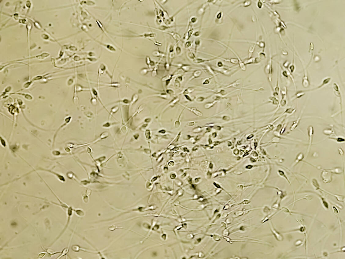 Männer mit schlechter Spermienqualität haben laut Studien ein erhöhtes Risiko für manche chronische Krankheiten und eine verkürzte Lebenserwartung. Ob das Spermiogramm im Umkehrschluss als Screeningmethode genutzt werden sollte, ist aber umstritten. / © Adobe Stock/Arif Biswas