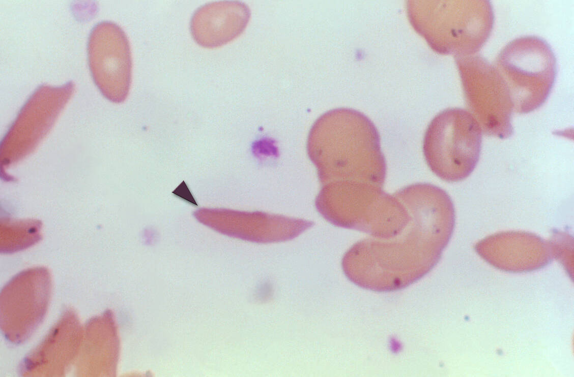 Typischer Befund bei Sichelzellerkrankung: Die Erythrozyten sind zu einer Sichelform deformiert.  / Foto: CDC