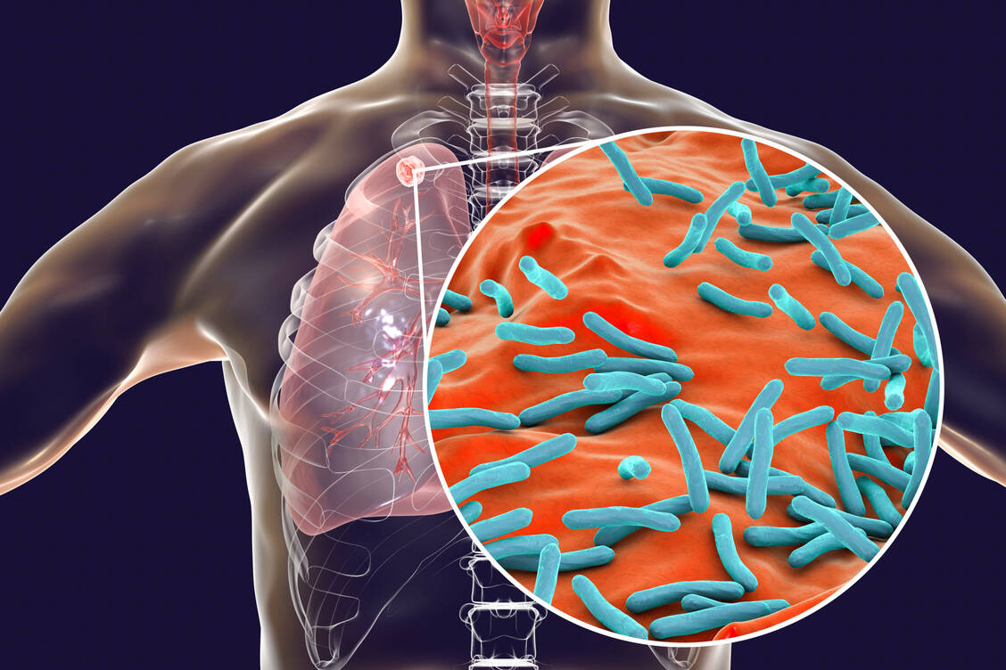 Etwa 10 Millionen Menschen erkranken pro Jahr neu an Tuberkulose, bei der Mycobacterium tuberculosis Entzündungen in der Lunge verursacht.  / Foto: Getty Images/Kateryna Kon/Science Photo Library