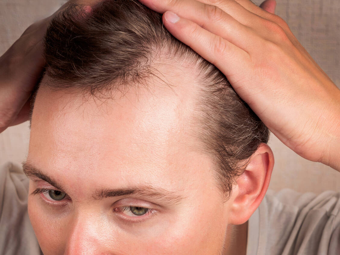 Die häufigste Form eines behandlungsbedürftigen Haarausfalls ist die androgenetische Alopezie. / © Shutterstock/daniiD