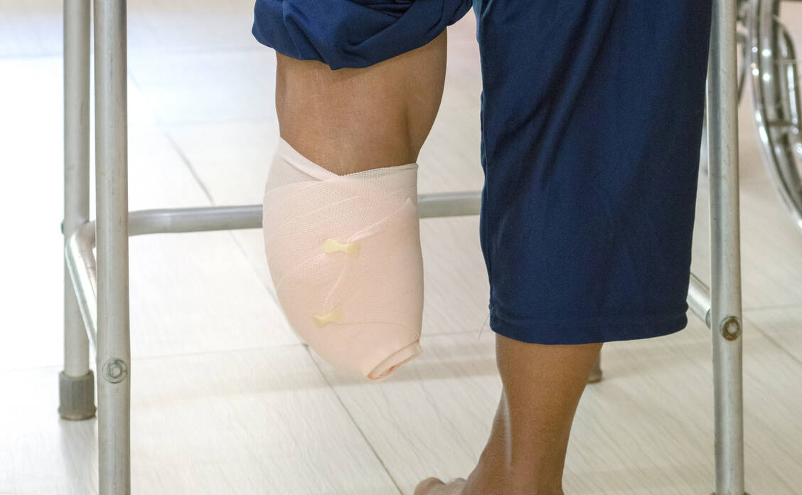 Ziel jeder Therapie des DFS ist die Vermeidung einer Amputation. / Foto: Adobe Stock/Choo