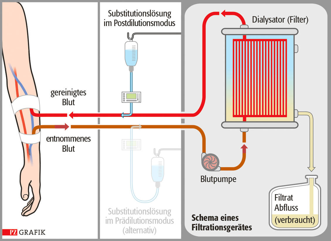Grafik 2: Kontinuierliche Nierenersatztherapie mittels Hämofiltration: Der Stofftransport erfolgt vorwiegend mittels Konvektion.  Grafik: Stephan Spitzer