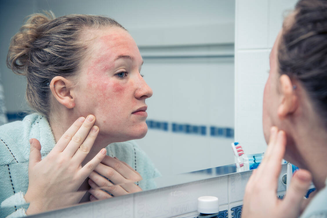 Hautveränderungen können viele Ursachen haben. Eine davon ist eine Arzneimittelunverträglichkeit oder -allergie. / Foto: Getty Images/AzmanL