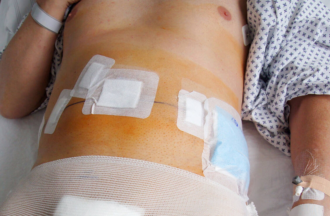 Die neueren Antibiotika-Kombinationen sind unter anderem bei Bauch- und Weichteilinfektionen zugelassen. / Foto: Adobe Stock/don57