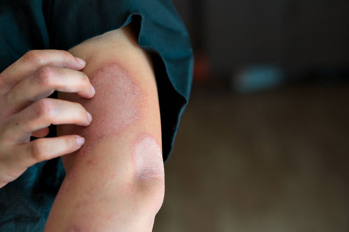 Das Zytokin Interleukin (IL)-23 spielt bei der Pathologie der Autoimmunerkrankung Psoriasis eine wichtige Rolle. / Foto: Shutterstock/sattahipbeach