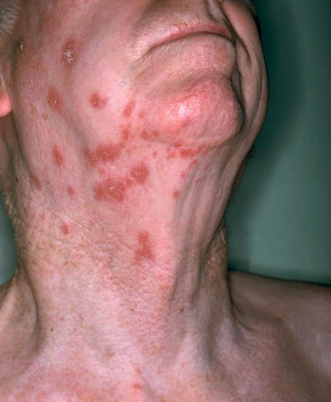 Eine Zoster-Erkrankung kann starke Schmerzen auslösen, die lange nach Abheilen der Hauterscheinungen anhalten.  Bei der Post-zoster-Neuralgie können Opioide helfen. / Foto: CDC