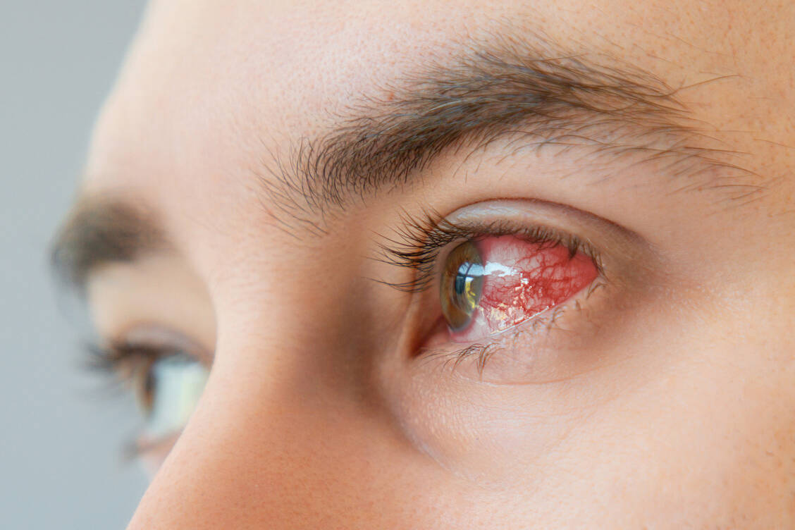 Oft geht eine infektiöse Keratitis auf den »Krankenhauskeim« Pseudomonas aeruginosa zurück. / © Imago/Depositphotos