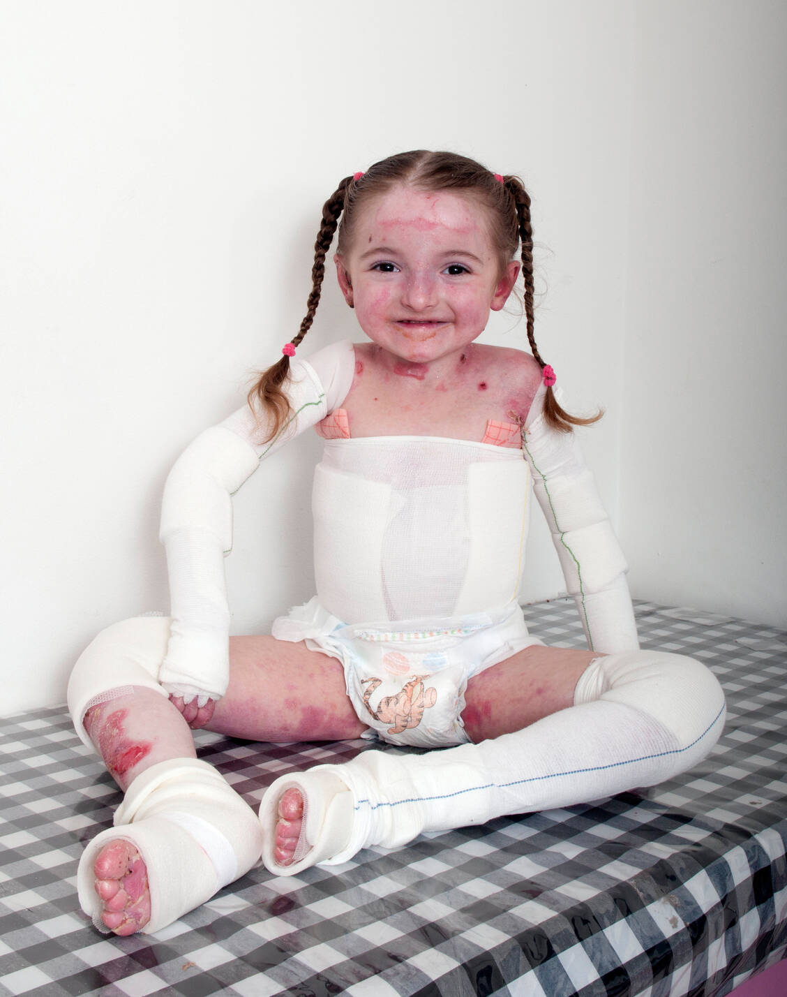 Die für die Erkrankung typischen Blasen müssen regelmäßig und sorgfältig versorgt werden, da sie sich ansonsten rasch vergrößern.  / Foto: Amryt Pharma