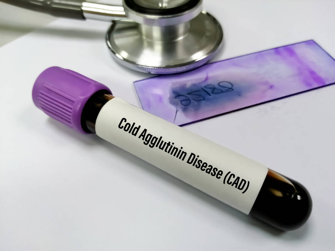 Bei der seltenen Kälteagglutinin-Krankheit (cold agglutinin disease, CAD) attackiert das Komplementsystem die Erythrozyten der Betroffenen und es kommt zur hämolytischen Anämie. / Foto: Adobe Stock/Saiful52