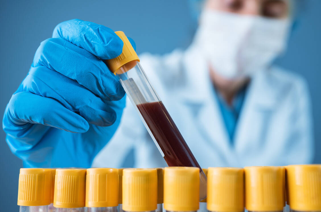 Zwar lässt sich bei Long-Covid-Patienten ein bestimmter immunologischer Phänotyp erkennen, die Diagnose des Syndroms kann aber mit nahezu 100-prozentiger Sicherheit anhand der Symptome gestellt werden. / Foto: Getty Images/busracavus