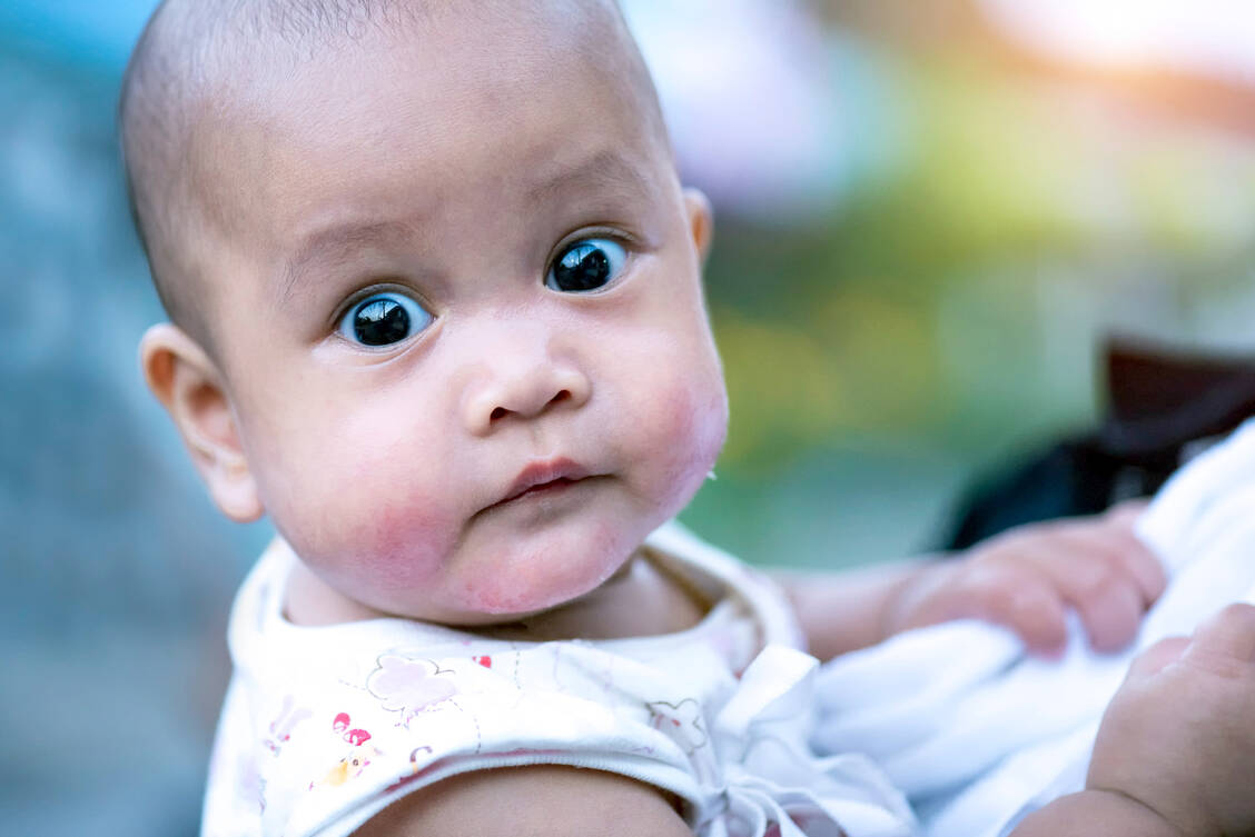 Die atopische Dermatitis manifestiert sich häufig schon vor dem ersten Lebensjahr, typischerweise im Gesicht. / © Getty Images/Virojt Changyencham