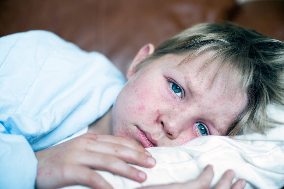 Masern zählen zu den wenigen Krankheiten, bei denen es nur einen humanpathogenen Erreger ohne tierisches Reservoir gibt. Daher wäre es biologisch und technisch machbar, das Virus auszurotten, wenn denn die Impfraten weltweit hoch genug wären. / Foto: Getty Images/CHBD