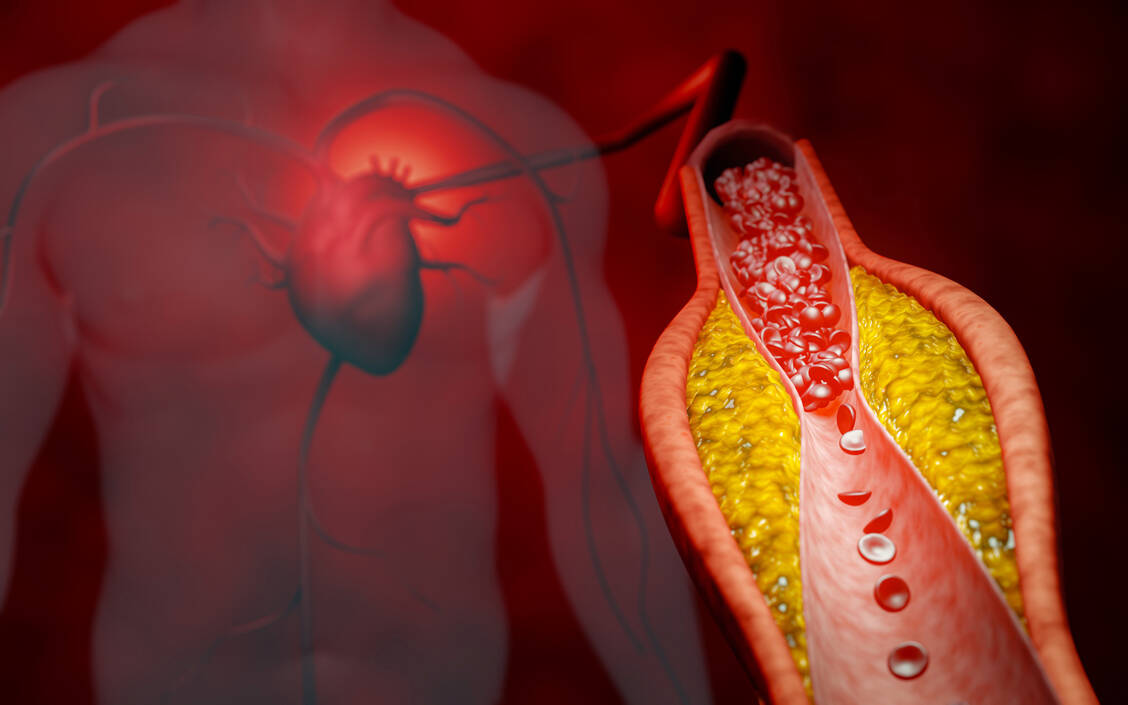 Lipoprotein(a) ist ähnlich aufgebaut wie das »schlechte« Cholesterol und kann wie dieses die Gefäße schädigen und Atherosklerose bedingen.  / © Adobe Stock/Superrider