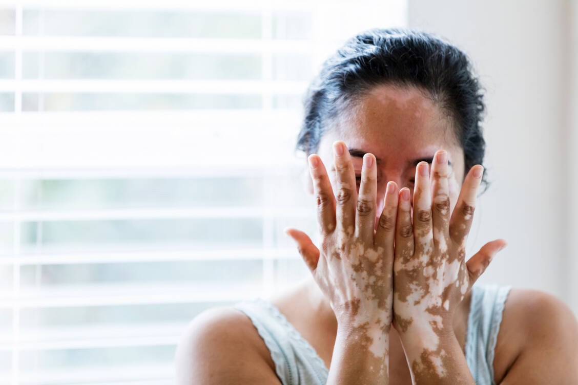 Eine Vitiligo als Arzneimittelfolge: Besonders die Therapie mit TNF-α-Inhibitoren wird damit in Zusammenhang gebracht. / Foto: Getty Images/kali9