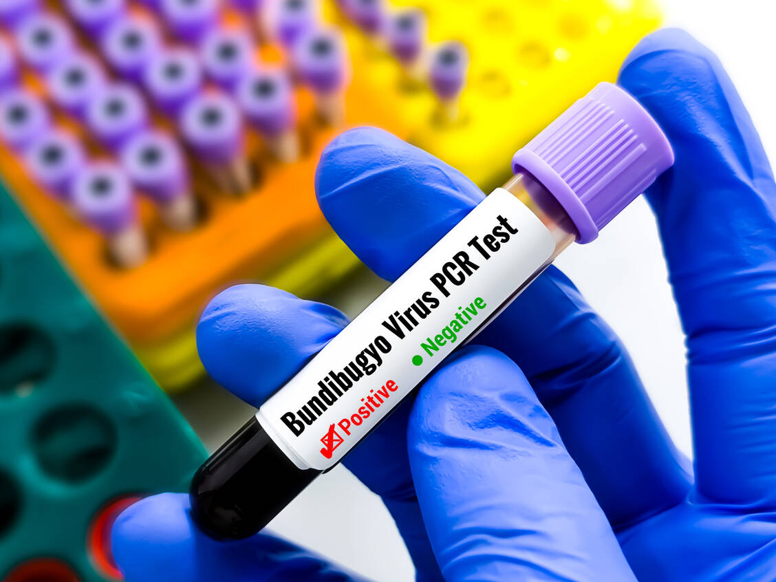 Der aktuelle Ausbruch der Ebolaerkrankung in Zentralafrika durch das Bundibgyo-Virus ist bereits jetzt größer als die beiden bisher bekannten Ausbrüche von 2007 (Uganda) und 2021 (Demokratische Republik Kongo). / © GettyImages/Md Saiful Islam Khan