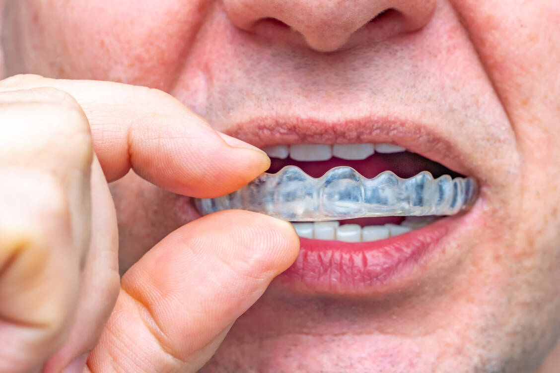 Eine Plastikschiene kann die Abnutzung der Zähne beim Knirschen verhindern. Sie sollte auf jeden Fall individuell angepasst sein. / Foto: Adobe Stock/stylefoto24