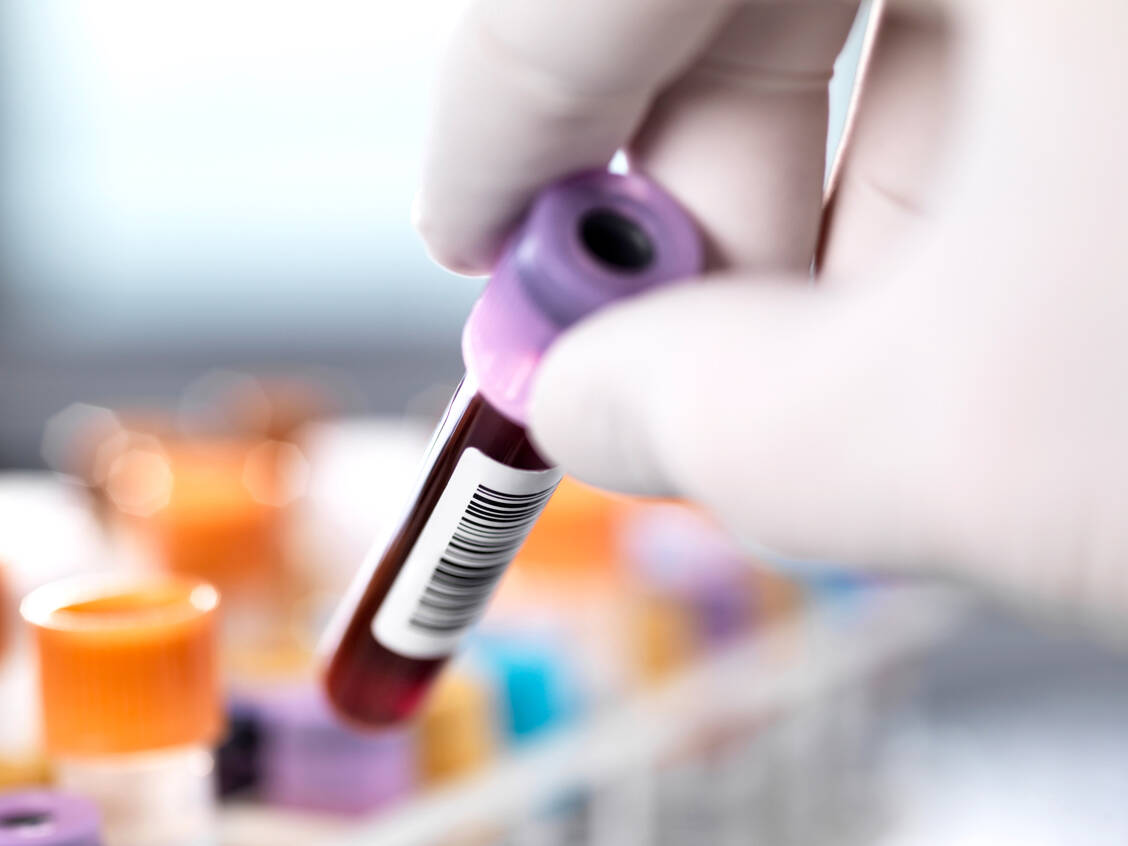 Die Spiegel einiger Proteine im Blut verändern sich schon Jahre vor einer Prostatakrebsdiagnose und könnten dazu genutzt werden, das Risiko für diese Krebsart zu ermitteln. / © Getty Images/Tek Image/Science Photo Library