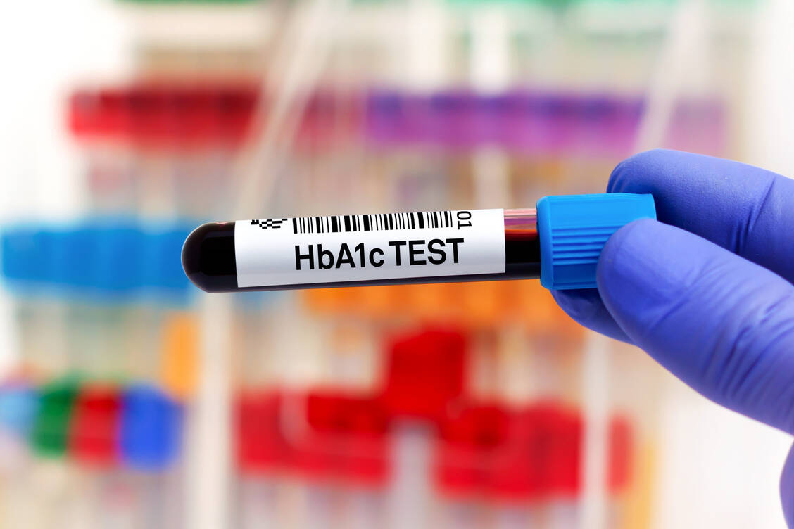 Der HbA<sub>1c</sub>-Wert ist zwar nicht unumstritten, aber momentan noch die gängigste Methode zur Messung des Langzeit-Blutzuckers. / Foto: Adobe Stock/angellodeco
