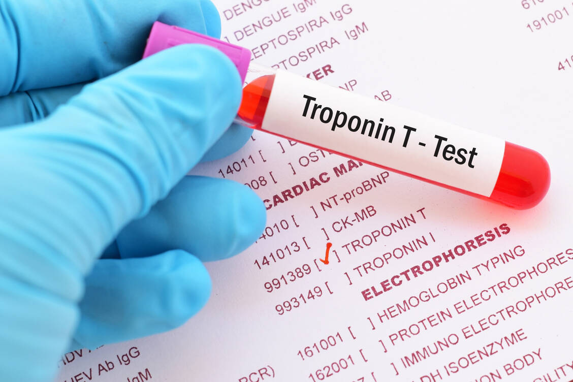 Troponin T ist aufgrund seiner Spezifität der wichtigste Laborwert bei Herzinfarkt. / Foto: Adobe Stock/jarun011