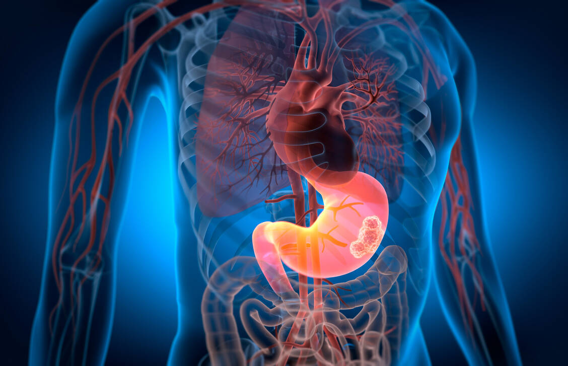 In Magenkarzinomen ist häufig das Protein Claudin18.2 überexprimiert. Gegen dieses richtet sich eine CAR-T-Zelltherapie, die in China entwickelt wurde.  / © Getty Images/peterschreiber.media