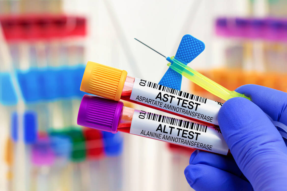 Stark erhöhte Transaminasewerte sind ein Merkmal der Hepatitis mit unklarer Ursache, an der zurzeit vor allem in Großbritannien Kinder und Jugendliche erkrankt sind. / Foto: Adobe Stock/angellodeco