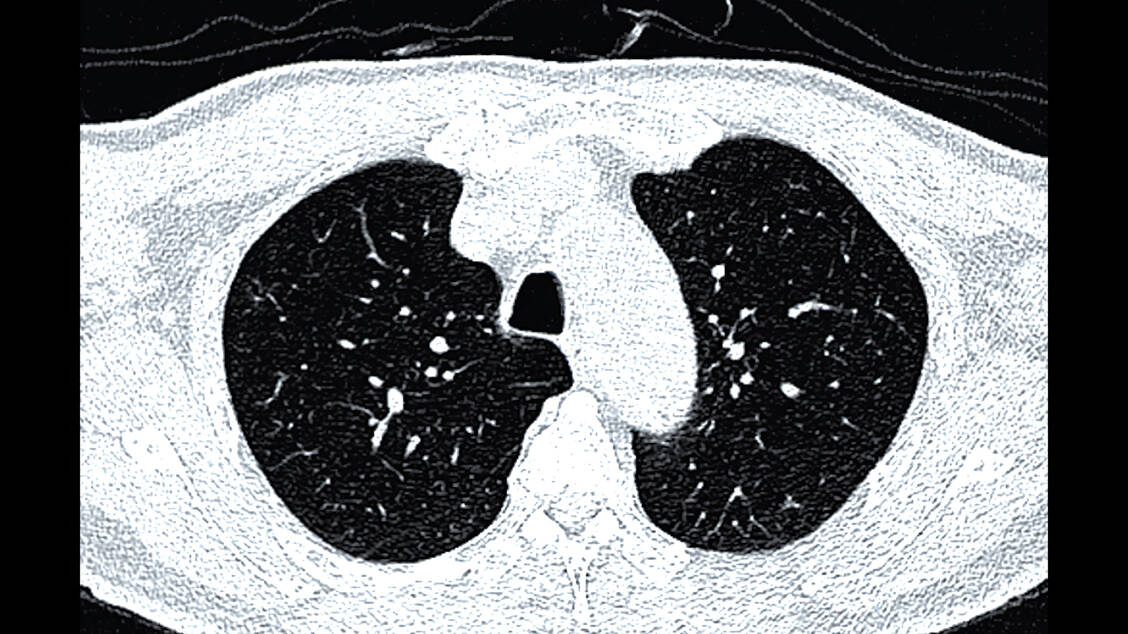 Eine Screening auf Lungenkrebs erfolgt bei berechtigten Personen einmal jährlich mittels Niedrigdosis-Computertomographie. / © shutterstock/Radiological imaging