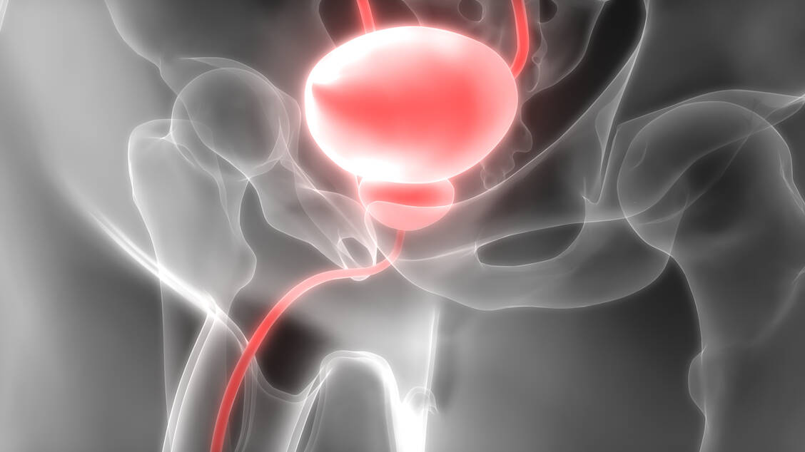 Urothel-Blasenkrebs beginnt in der Schleimhaut der Harnblase (Urothelzellen oder Übergangsepithelzellen) und kann sich nicht-invasiv oder invasiv gestalten. / Foto: Adobe Stock/magicmine