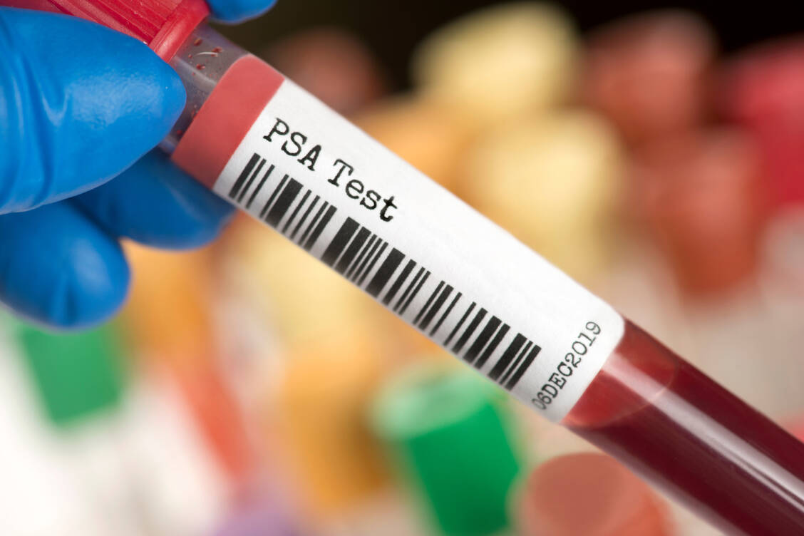 Der Wert des Prostata-spezifischen Antigens (PSA) wird im Blut bestimmt. Eine Krebserkrankung der Prostata, aber auch eine gutartige Vergrößerung des Organs, mechanische Reize oder andere Ursachen können den PSA-Wert erhöhen. / © Adobe Stock/Sherry Young
