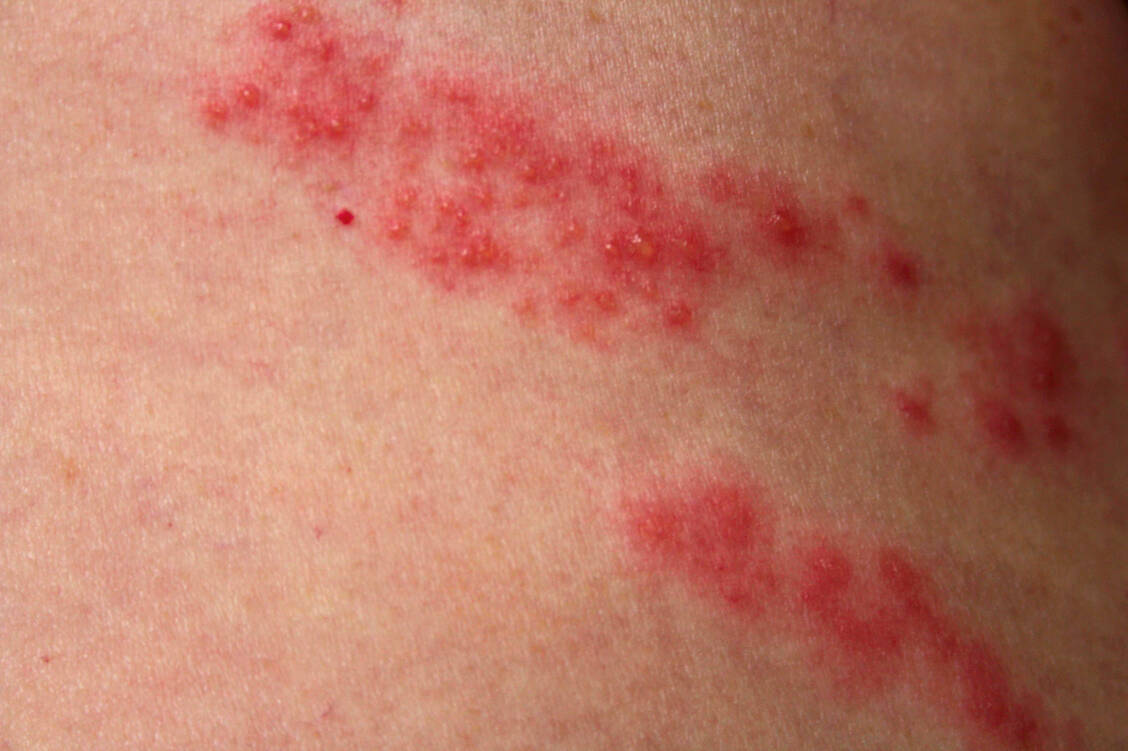 Bei Patienten mit Gürtelrose tritt ein typischer Hautausschlag mit Bläschenbildung auf. / Foto: Imago/Chromorange