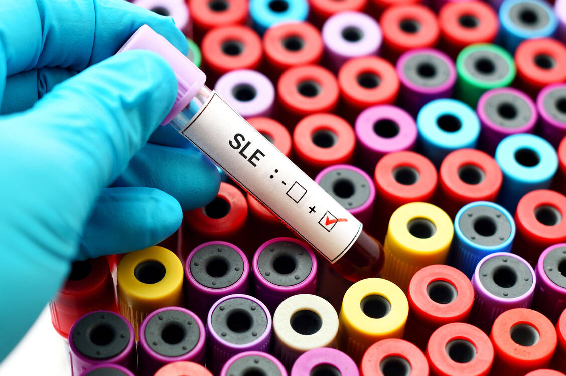 Bei klinischem Verdacht unterstützen Laborparameter die Diagnose eines systemischen Lupus erythematodes, darunter serologische Parameter. / Foto: Adobe Stock/jarun011