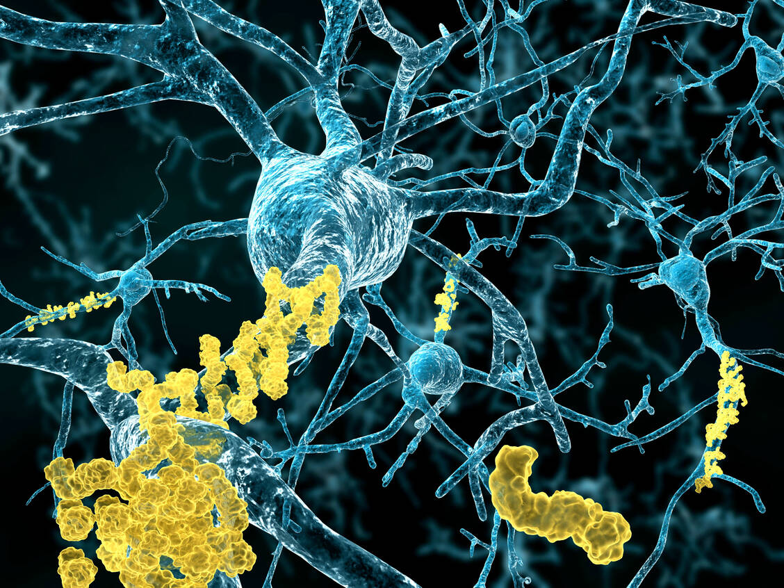 β-Amyloid-Plaques bilden sich bei Alzheimer-Patienten extrazellulär im Gehirn und stehen unter Verdacht, die Erkrankung auszulösen. An diesen Ablagerungen greift der Antikörper Lecanemab an und sorgt für deren Abbau. / Foto: Adobe Stock/Juan Gärtner