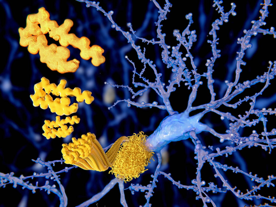 β-Amyloid-Plaques sind eine auffällige Besonderheit im Gehirn von Alzheimer-Patienten. Der Antikörper Aducanumab verhindert ihre Bildung, indem er β-Amyloid abbaut. / Foto: Getty Images/selvanegra