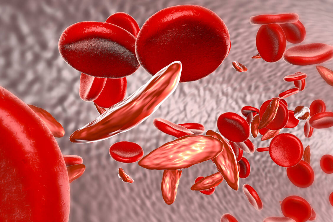 Typisch geformte Erythrozyten: Sichelzellen / Foto: Shutterstock/Kateryna Kon