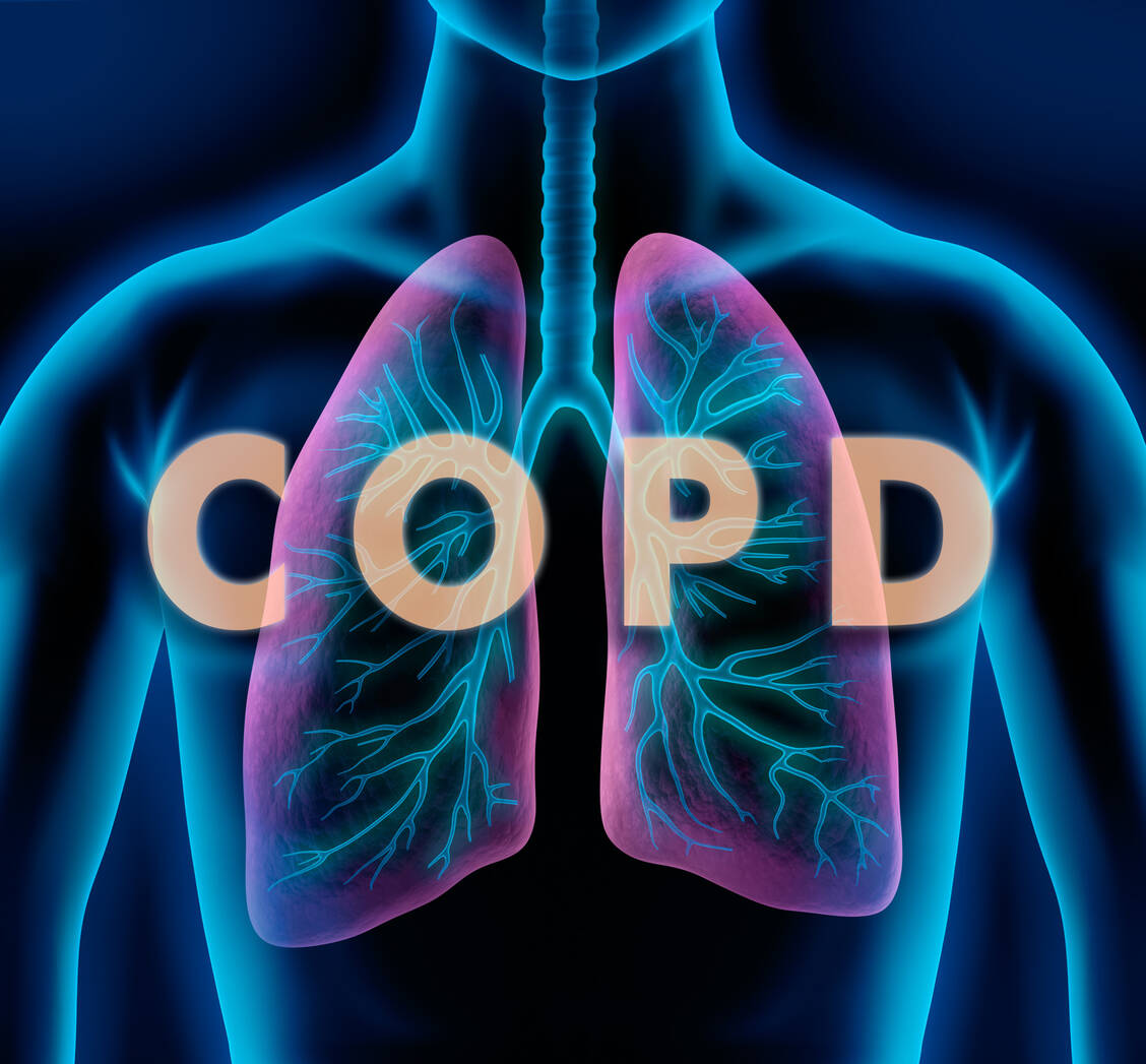 Für die Therapie der COPD gibt es bisher keine zugelassenen Biologika. / Foto: Adobe Stock/peterschreiber.media