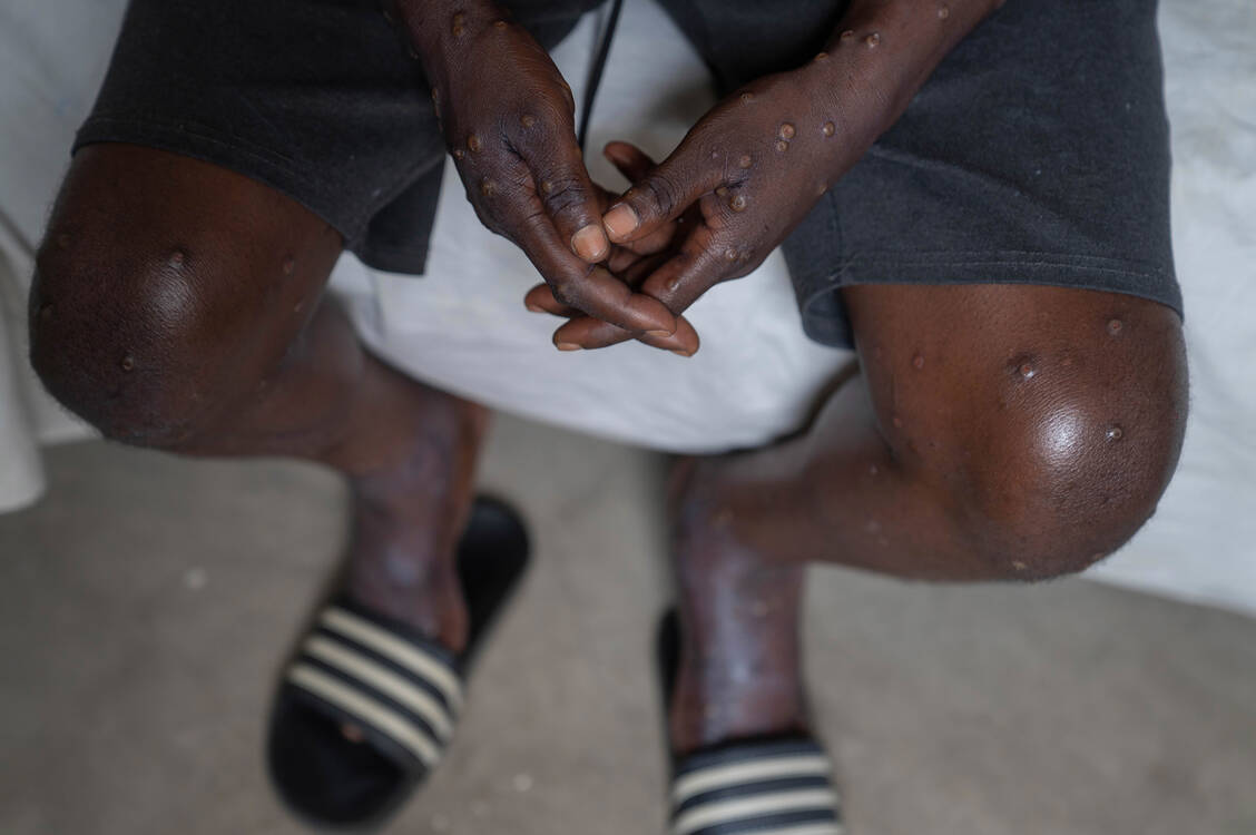 Eine schwere Mpox-Erkrankung liegt laut WHO-Definition vor, wenn ein Patient 100 oder mehr Hautläsionen aufweist. / Foto: Picture Alliance/Associated Press