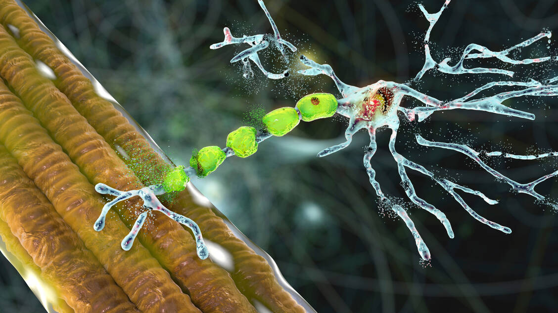 Die amyotrophe Lateralsklerose, kurz ALS, ist eine fortschreitende Motoneuronen-Erkrankung.  / Foto: Adobe Stock/Kateryna_Kon