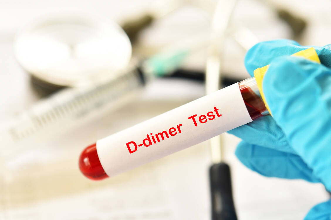 Bei einer schweren Covid-19-assoziierten Koagulopathie sind die D-Dimere meist deutlich erhöht. Bei hospitalisierten Betroffenen wird in einer Studie  rNAPc2 subkutan verabreicht. / Foto: Adobe Stock/jarun011