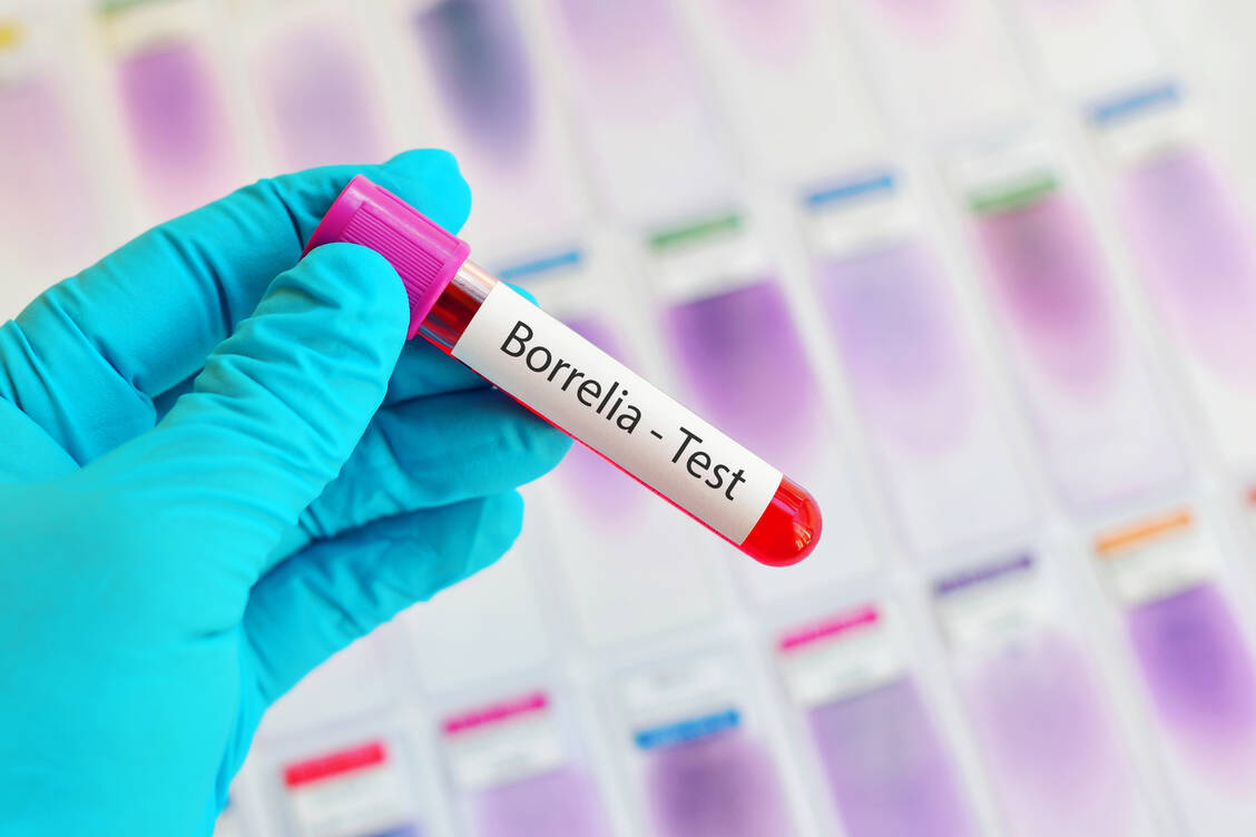 Nicht alle Symptome, die potenziell auf eine Lyme-Borreliose hindeuten, sind tatsächlich auf diese Erkrankung zurückzuführen. / Foto: Adobe Stock/jarun011