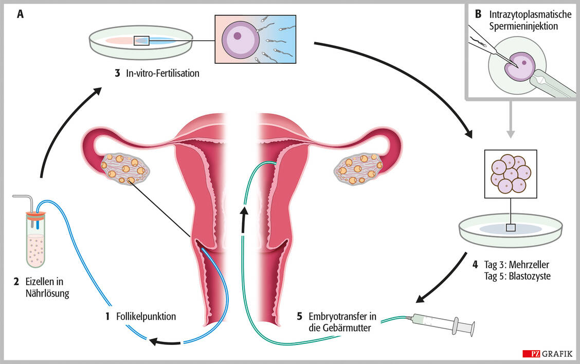 Abbildung 1: Ablauf der assistierten Reproduktion: Mit einer Hohlnadel werden die Follikel unter Ultraschallkontrolle transvaginal punktiert und die Eizellen abgesaugt (links unten). Nach Befruchtung im Reagenzglas (In-vitro-Fertilisation, IVF) oder per intrazytoplasmatischer Spermien injektion (ICSI) (rechts oben) werden einer oder mehrere Embryonen in den Uterus rücktransferiert (rechts unten). / Foto: Stephan Spitzer