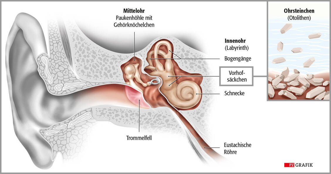 Grafik: Anatomie des Ohres mit dem Vestibularapparat im Innenohr; Ausschnitt rechts: losgelöste Ohrsteinchen bei Lagerungsschwindel / © PZ/Stephan Spitzer