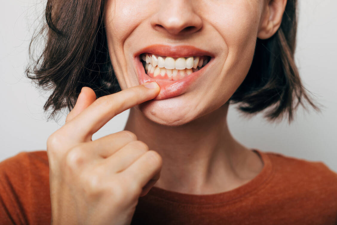 Kommt es unter der Anwendung von Metamizol zu schmerzhaften Entzündungen der Schleimhäute, soll das Mittel sofort abgesetzt und ein Arzt aufgesucht werden. / Foto: Adobe Stock/Maksym Povozniuk