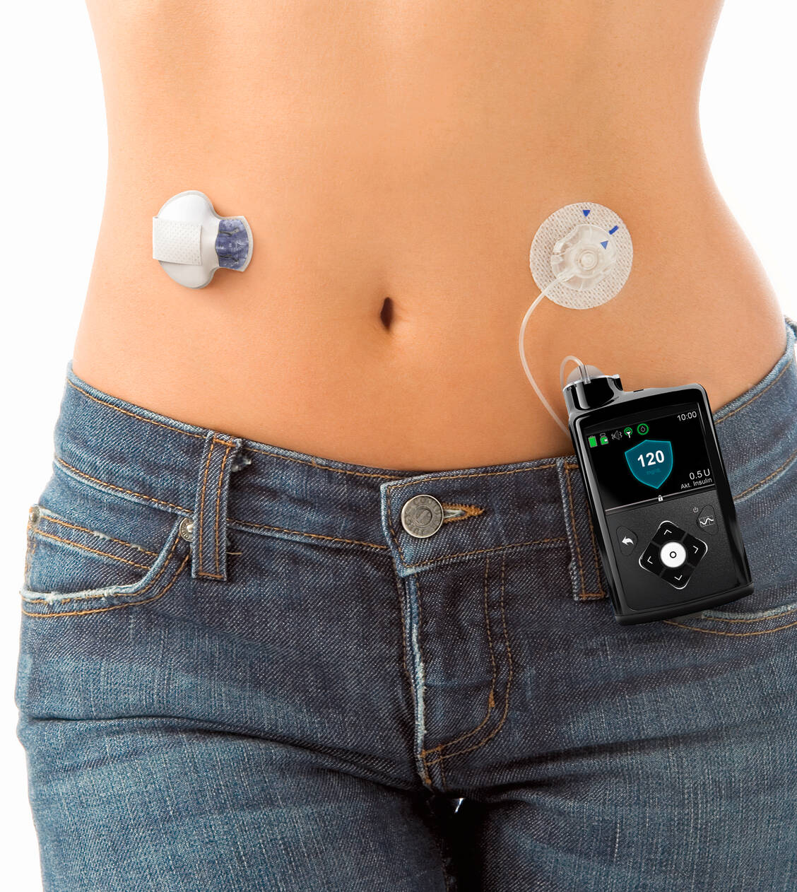Das Closed-Loop-System MiniMed 670G ist jetzt in Deutschland verfügbar. Es misst kontinuierlich den Blutzuckerwert und passt die basale Insulingabe entsprechend an. / Foto: Medtronic